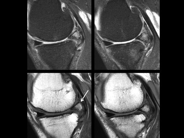 Figure 4 for case meniscal ossicle